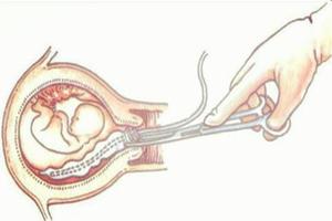 鸡西三个月能做无痛引产手术吗(三个月可做引产无)