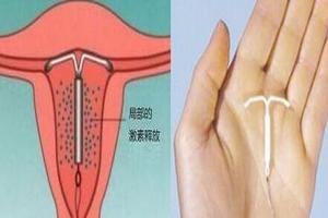 鸡西当时做完人流能上环吗(刚做完人流手术可以上节育环吗?)