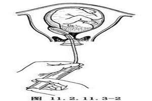 鸡西7个月引产有无痛的吗(七个月引产需要插尿管吗)