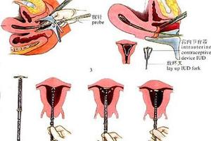 鸡西取环后怀孕可以吗(取环了可以怀孕吗)