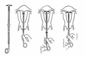 鸡西上环后月经多 取环后少(节育环取出后月经量多)