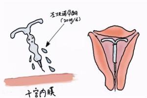 鸡西打胎清宫能直接上环吗(清宫手术可以直接上环吗)