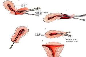 鸡西取环前做什么准备工作(取环之前要做些什么检查)