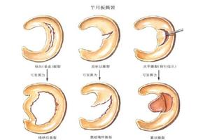 鸡西六个半月做引产(四个半月做引产危险吗)